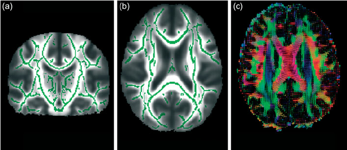 From-diffusion-tensor-imaging-measures-of-fractional-anisotropy-FA-can-be-derived
